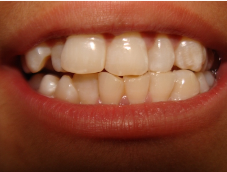 سوء الإطباق